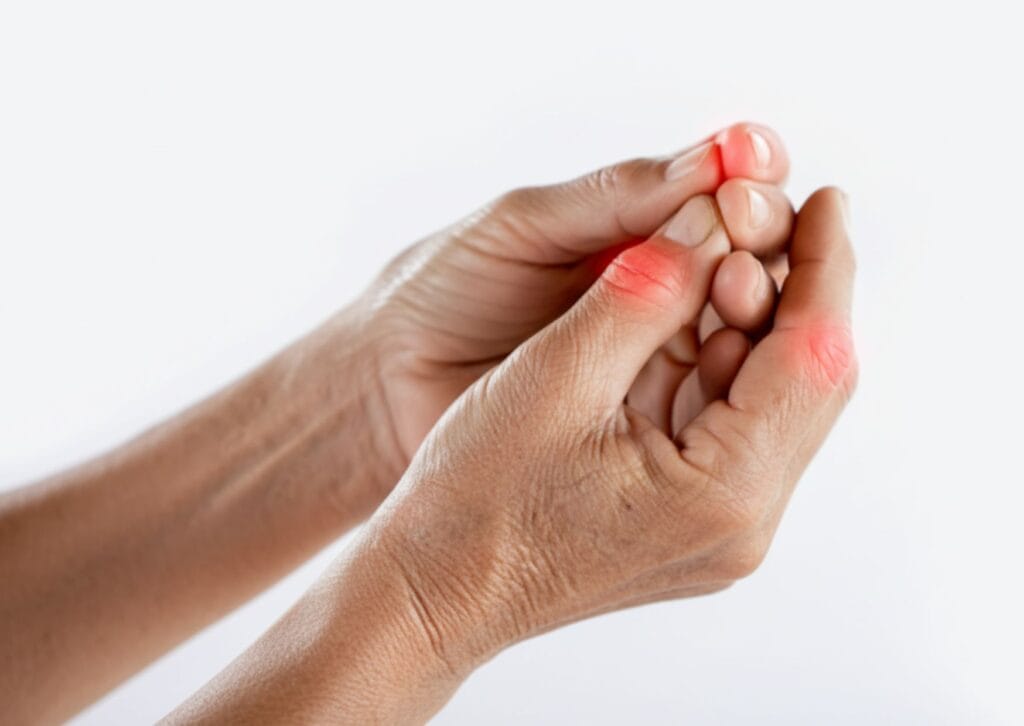 artrosis en las manos