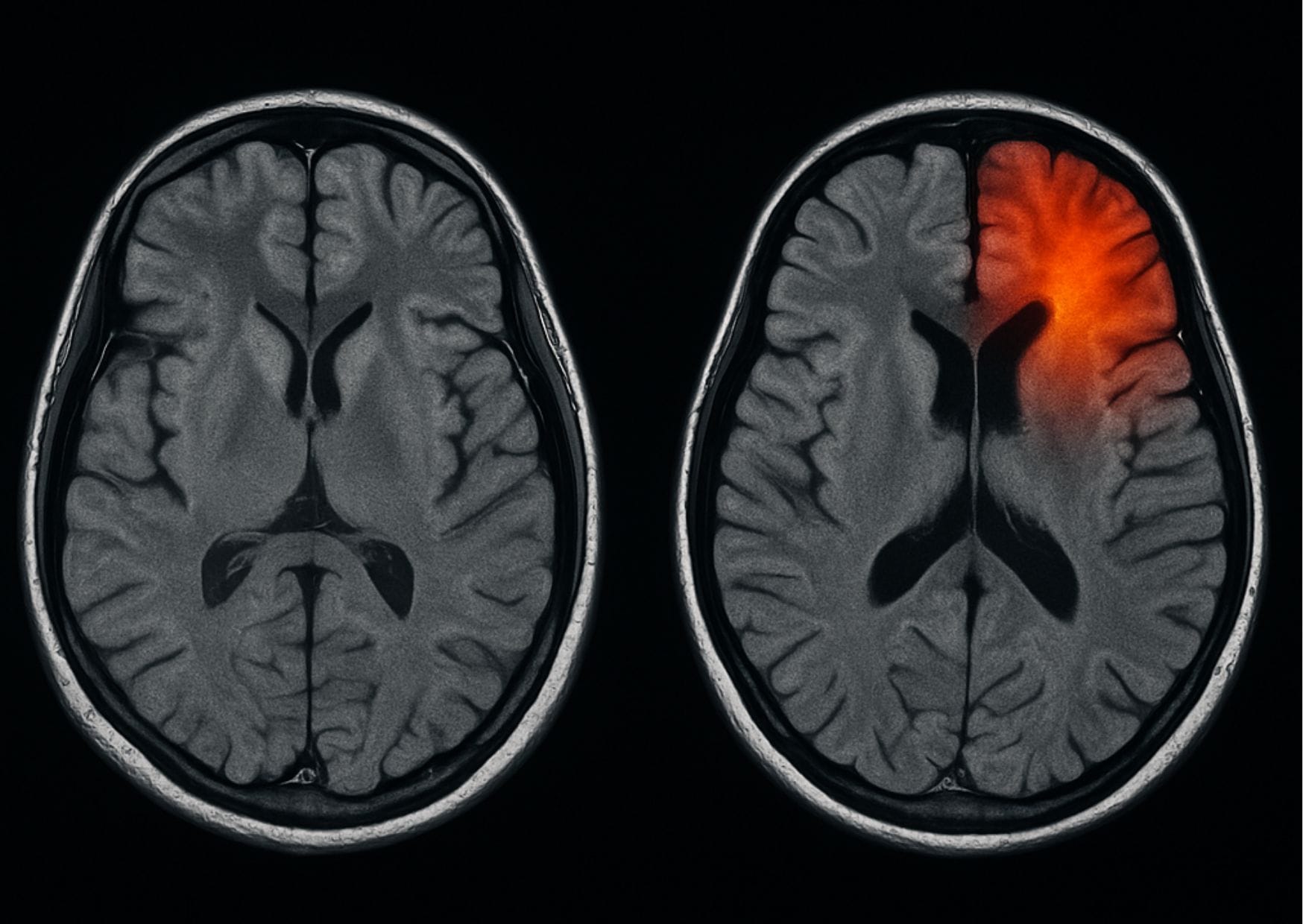 Rehabilitación de un Ictus, causas, síntomas, factores de riesgo