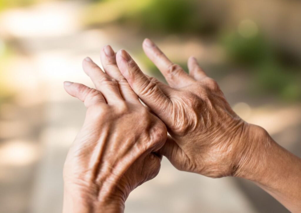 artritis en las manos